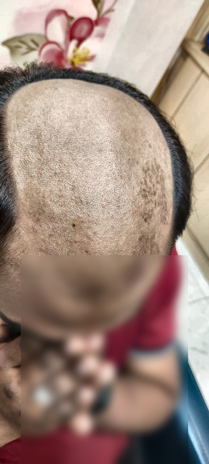 Front Hairline Hair Patch: The Complete Guide