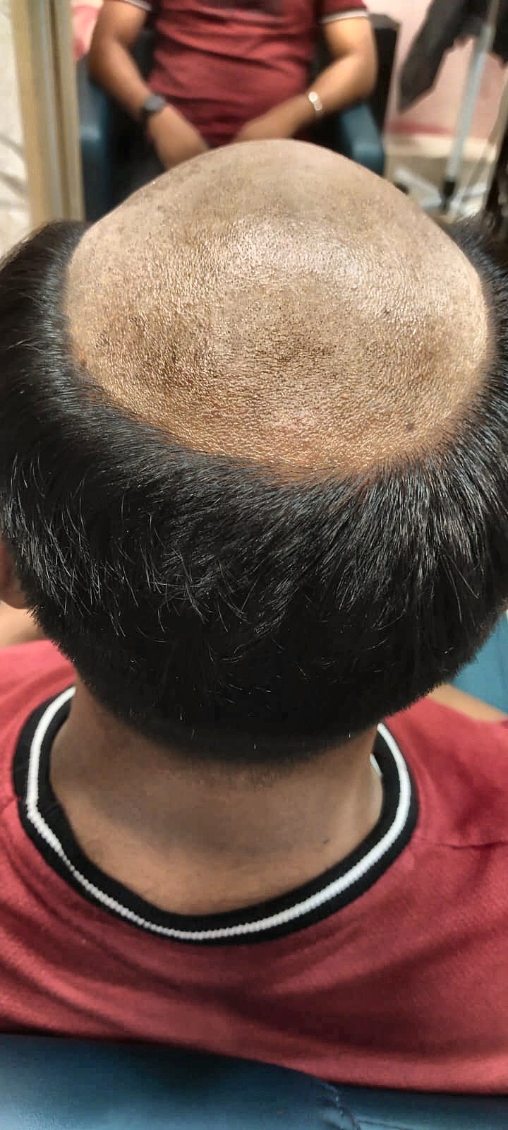 How Long Does a Hair Patch Last? (Plus 7 Ways to Double Its Life)